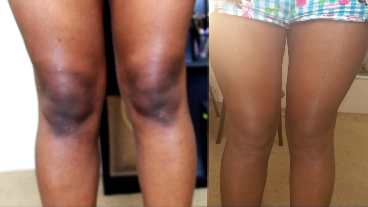 Any Lady Who Has Dark Knees, Chances Are That She Prefers D0ggy Style–Research