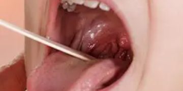 People Who Lick Women And Suck Balls Are At High Risk Of Throat Cancer–Experts Warn Lickers