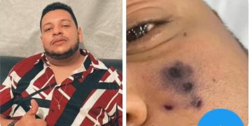 Sad News: Popular Brazilian Singer Dead After Being Bitten By Spider