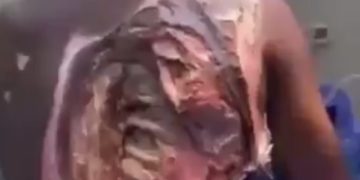 Women Are W!cked! Man In Critical Condition After Jealous Wife P0ured Acid On Him Over His Plans To Marry A Second Wife—Video