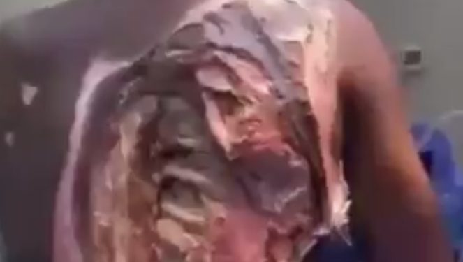 Women Are W!cked! Man In Critical Condition After Jealous Wife P0ured Acid On Him Over His Plans To Marry A Second Wife—Video