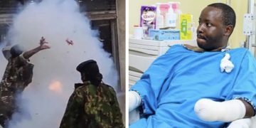 Doctors Cut Off Hands Of Top Kenyan Police Officer After A Teargas He Was Throwing At Peaceful Protesters In Nairobi Blew Up While Holding It